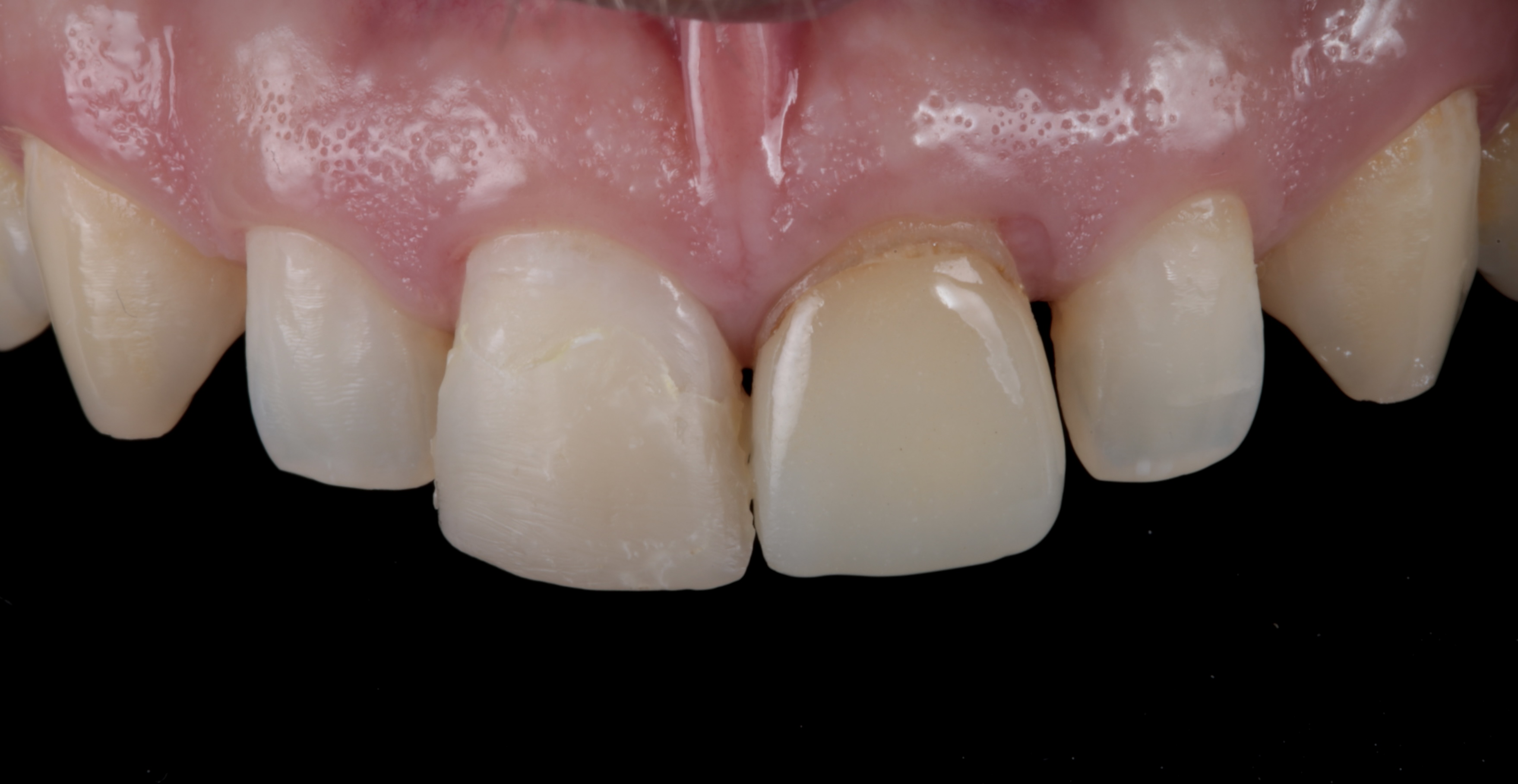 Situación inicial intraoral
