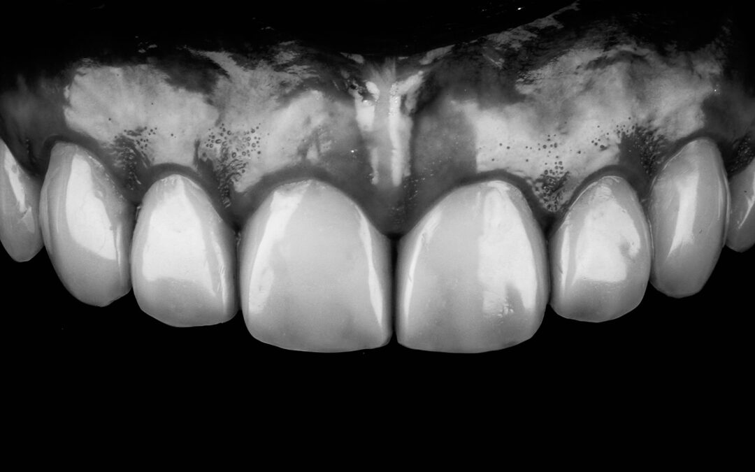 Dr. Rafael Calixto. Curso intensivo, carillas, resinas y rehabilitación funcional